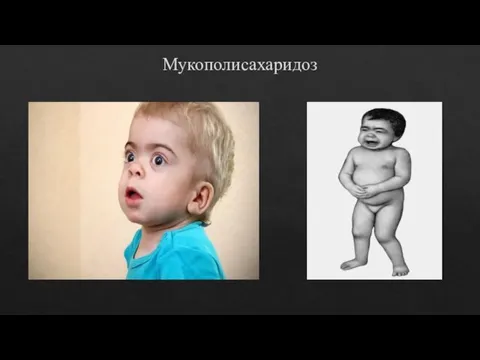 Мукополисахаридоз