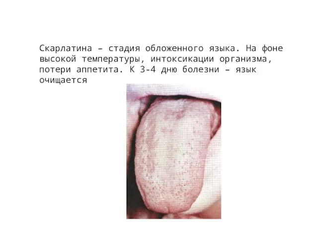 Скарлатина – стадия обложенного языка. На фоне высокой температуры, интоксикации организма, потери