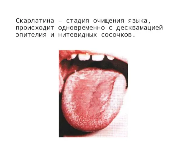 Скарлатина – стадия очищения языка, происходит одновременно с десквамацией эпителия и нитевидных сосочков.