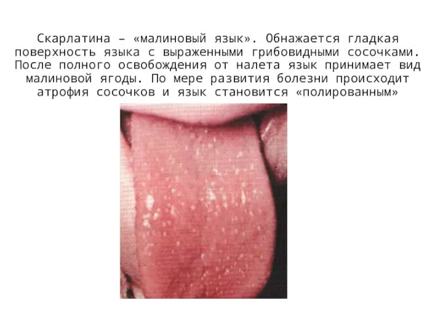 Скарлатина – «малиновый язык». Обнажается гладкая поверхность языка с выраженными грибовидными сосочками.