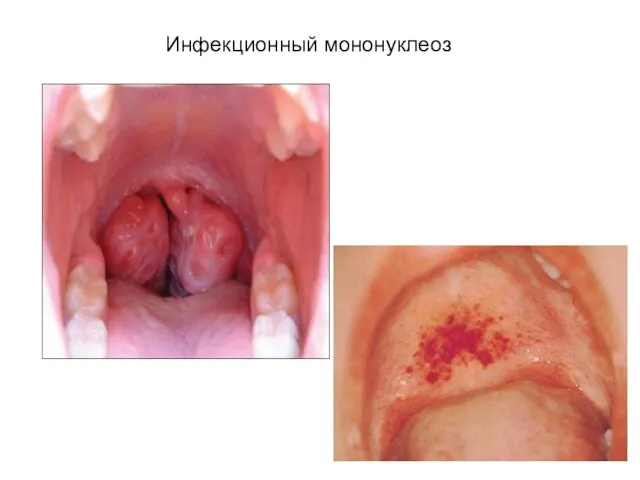 Инфекционный мононуклеоз