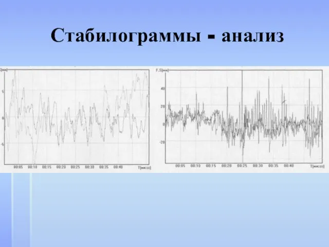 Стабилограммы - анализ