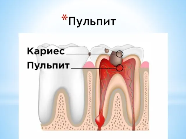 Пульпит