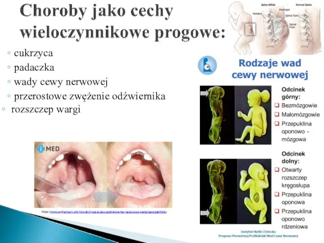 cukrzyca padaczka wady cewy nerwowej przerostowe zwężenie odźwiernika rozszczep wargi https://www.estheticon.pl/chirurdzy/rozszczep-podniebienia-rozszczep-wargi/georgia/tbilisi