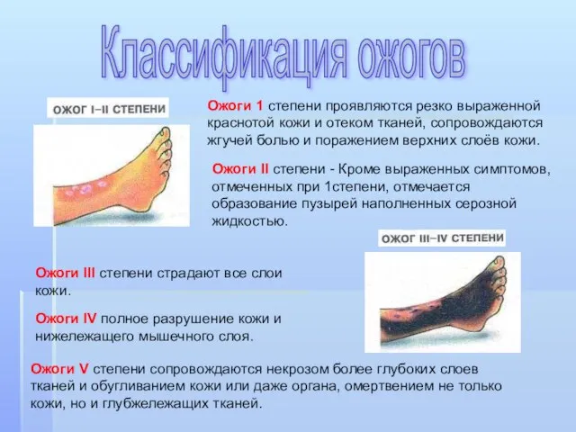 Ожоги 1 степени проявляются резко выраженной краснотой кожи и отеком тканей, сопровождаются