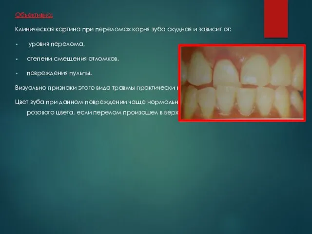 Объективно: Клиническая картина при переломах корня зуба скудная и зависит от: уровня