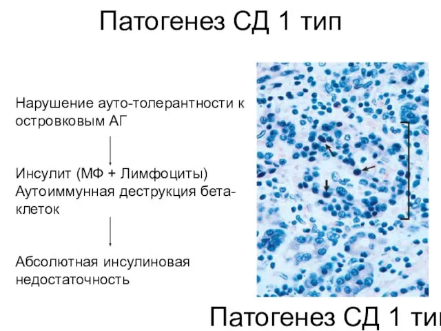 Патогенез СД 1 тип Патогенез СД 1 тип Нарушение ауто-толерантности к островковым