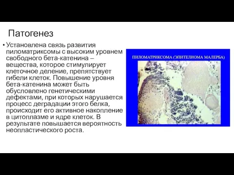 Патогенез Установлена связь развития пиломатриксомы с высоким уровнем свободного бета-катенина ‒ вещества,