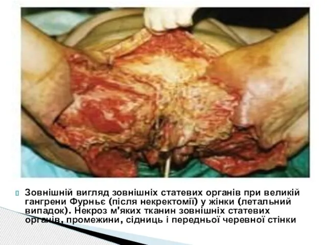 Зовнішній вигляд зовнішніх статевих органів при великій гангрени Фурньє (після некректомії) у