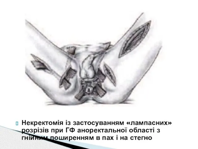 Некректомія із застосуванням «лампасних» розрізів при ГФ аноректальної області з гнійним поширенням