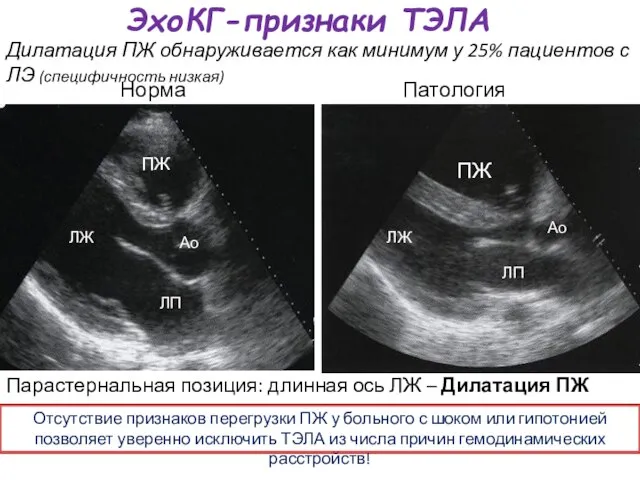 ЭхоКГ-признаки ТЭЛА Парастернальная позиция: длинная ось ЛЖ – Дилатация ПЖ ПЖ ЛЖ