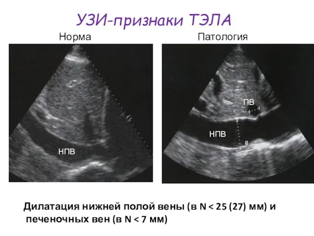 УЗИ-признаки ТЭЛА Дилатация нижней полой вены (в N НПВ ПВ Норма Патология НПВ