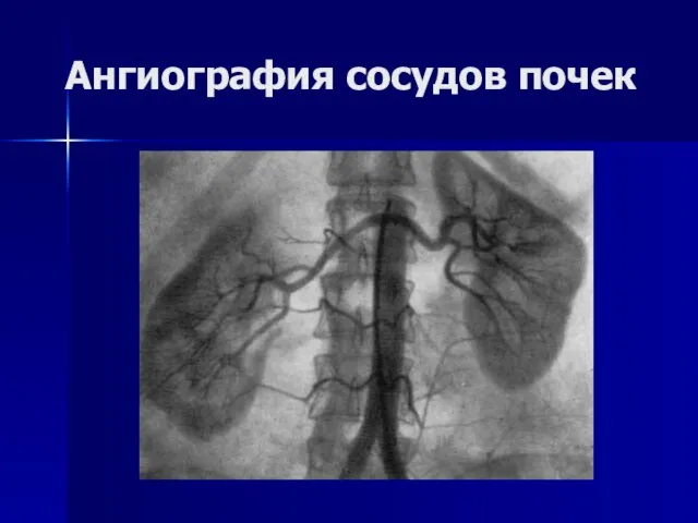 Ангиография сосудов почек