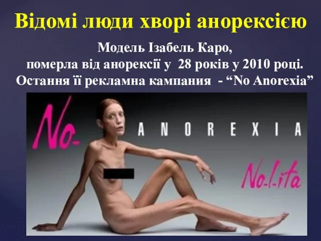 Відомі люди хворі анорексією Модель Ізабель Каро, померла від анорексії у 28