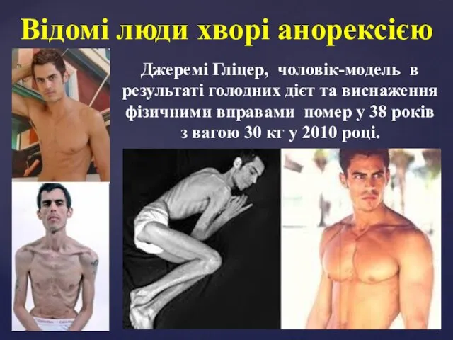 Відомі люди хворі анорексією Джеремі Гліцер, чоловік-модель в результаті голодних дієт та