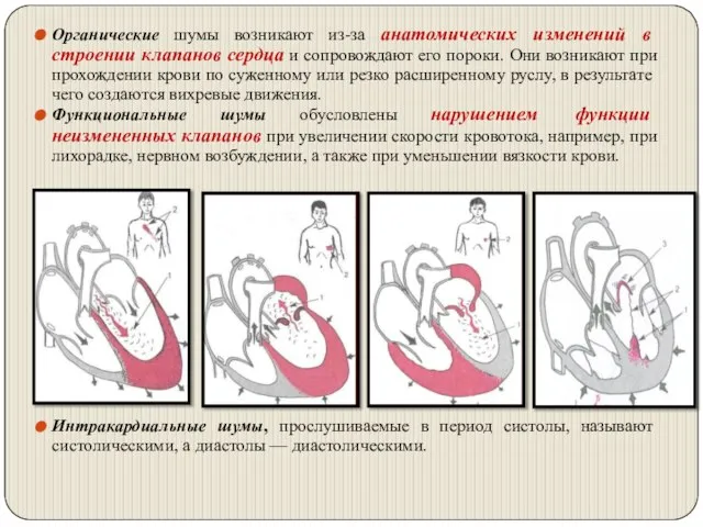 Органические шумы возникают из-за анатомических изменений в строении клапанов сердца и сопровождают