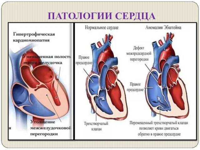 ПАТОЛОГИИ СЕРДЦА