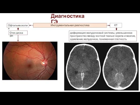 Диагностика ГЭ Инструментальная диагностика Офтальмоскопия КТ Отек диска ЗН деформация желудочковой системы,