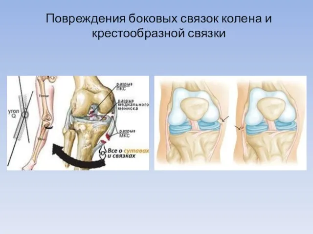 Повреждения боковых связок колена и крестообразной связки