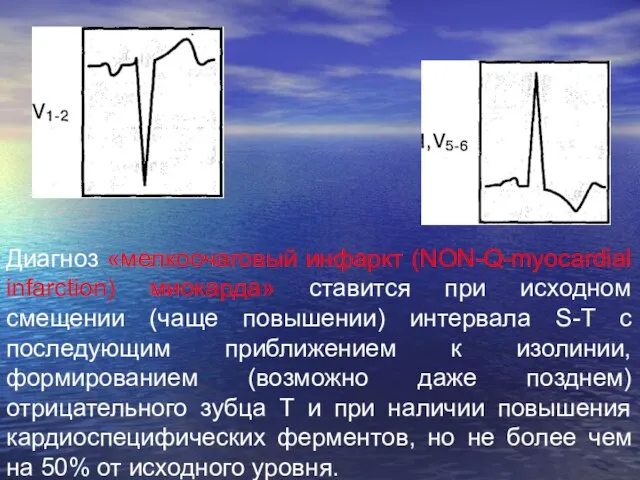 Диагноз «мелкоочаговый инфаркт (NON-Q-myocardial infarction) миокарда» ставится при исходном смещении (чаще повышении)