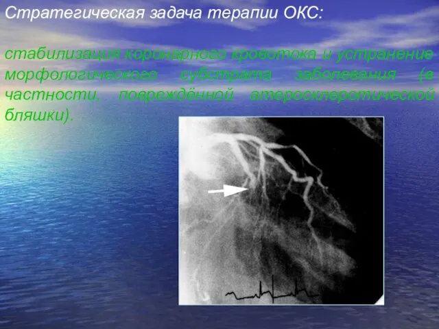 Стратегическая задача терапии ОКС: стабилизация коронарного кровотока и устранение морфологического субстрата заболевания