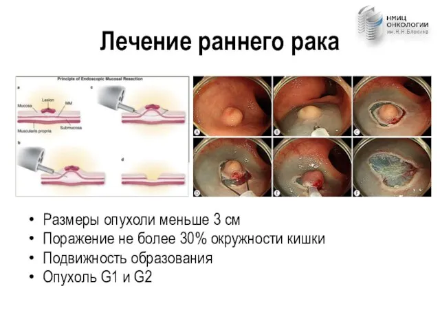 Лечение раннего рака Размеры опухоли меньше 3 см Поражение не более 30%