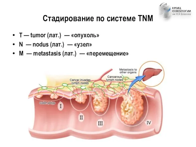 Стадирование по системе TNM T — tumor (лат.) — «опухоль» N —