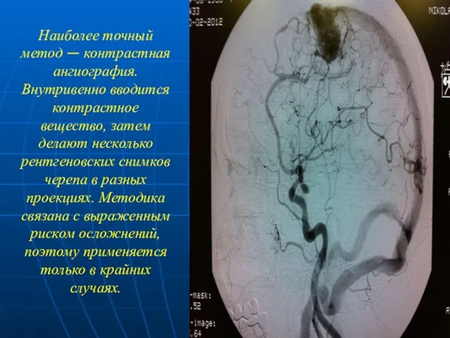 Наиболее точный метод — контрастная ангиография. Внутривенно вводится контрастное вещество, затем делают