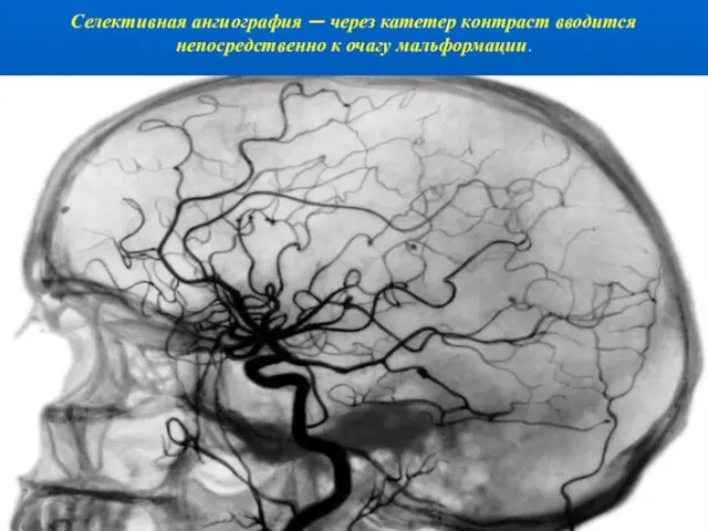 Селективная ангиография — через катетер контраст вводится непосредственно к очагу мальформации.