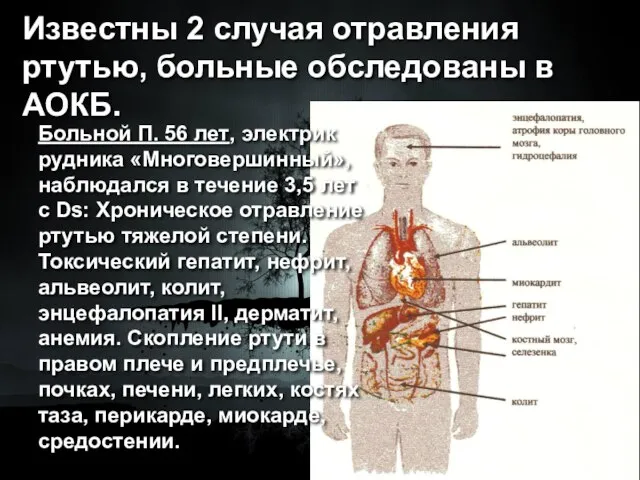 Известны 2 случая отравления ртутью, больные обследованы в АОКБ. Больной П. 56