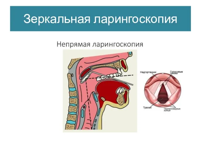 Зеркальная ларингоскопия