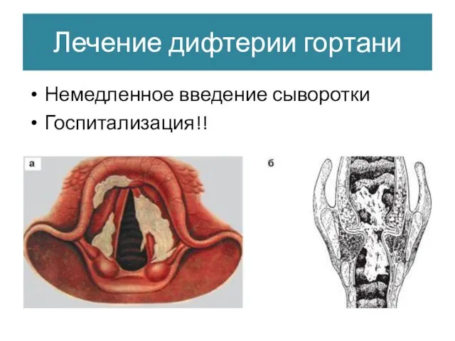 Лечение дифтерии гортани Немедленное введение сыворотки Госпитализация!!