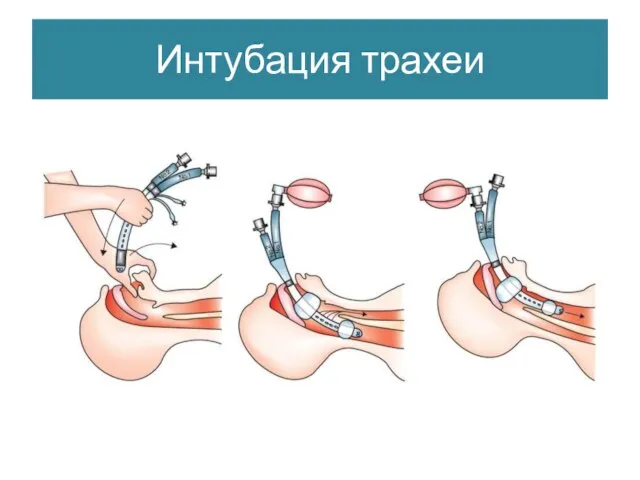 Интубация трахеи