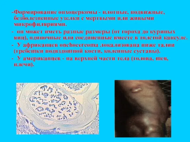 Формирование онхоцеркомы - плотные, подвижные, безболезненные узелки с мертвыми или живыми микрофиляриями.