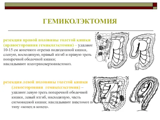 ГЕМИКОЛЭКТОМИЯ резекция правой половины толстой кишки (правосторонняя гемиколэктомия) – удаляют 10-15 см