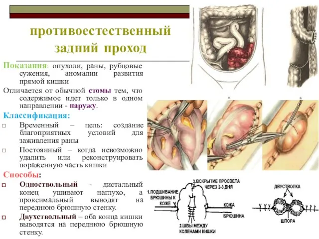 противоестественный задний проход Показания: опухоли, раны, рубцовые сужения, аномалии развития прямой кишки