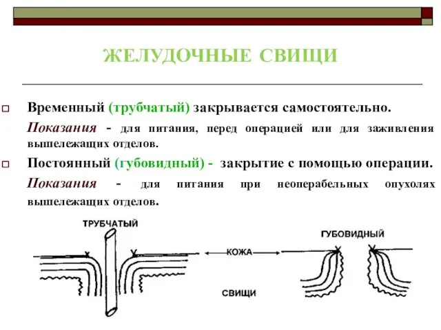 ЖЕЛУДОЧНЫЕ СВИЩИ Временный (трубчатый) закрывается самостоятельно. Показания - для питания, перед операцией