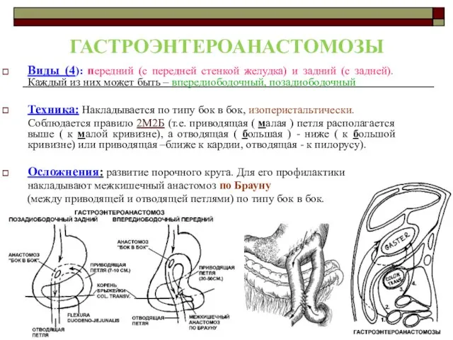 ГАСТРОЭНТЕРОАНАСТОМОЗЫ Виды (4): передний (с передней стенкой желудка) и задний (с задней).