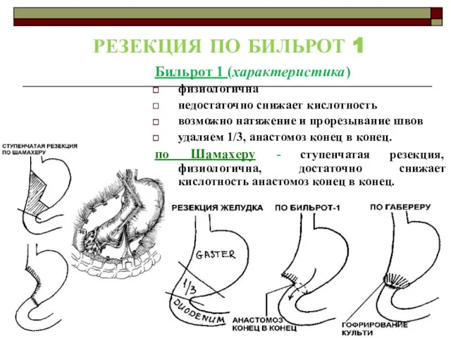 РЕЗЕКЦИЯ ПО БИЛЬРОТ 1 Бильрот 1 (характеристика) физиологична недостаточно снижает кислотность возможно