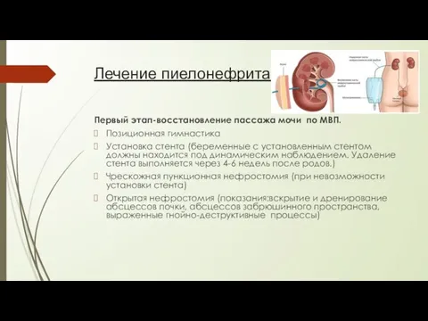 Лечение пиелонефрита Первый этап-восстановление пассажа мочи по МВП. Позиционная гимнастика Установка стента