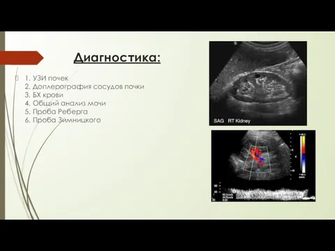 Диагностика: 1. УЗИ почек 2. Доплерография сосудов почки 3. БХ крови 4.