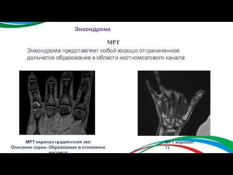 Энхондрома МРТ Энхондрома представляет собой хорошо отграниченное дольчатое образование в области костномозгового