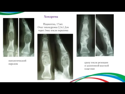 Хондрома Пациентка, 17лет. Очаг энхондромы 2,3х1,2см через 3мес после перелома патологический перелом