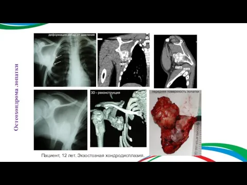 Остеохондрома лопатки Пациент, 12 лет. Экзостозная хондродисплазия.