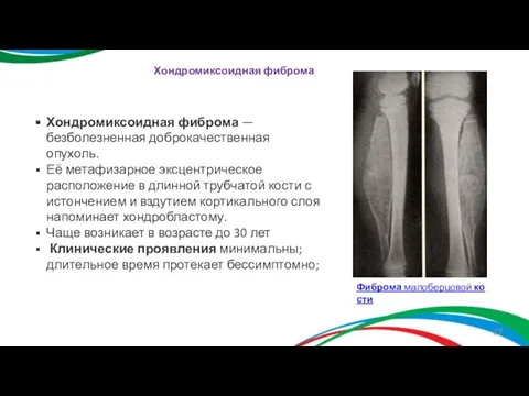 Хондромиксоидная фиброма — безболезненная доброкачественная опухоль. Её метафизарное эксцентрическое расположение в длинной