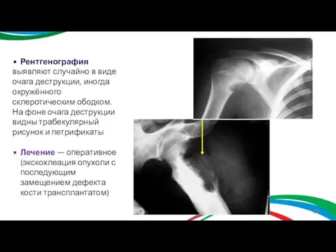 Рентгенография выявляют случайно в виде очага деструкции, иногда окружённого склеротическим ободком. На