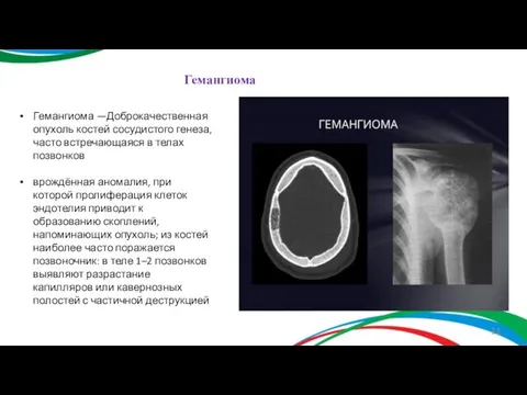 Гемангиома —Доброкачественная опухоль костей сосудистого генеза, часто встречающаяся в телах позвонков врождённая