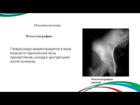 Остеоид-остеома Рентгенография Гнездо/нидус визуализируется в виде хорошо отграниченной зоны просветления, иногда с