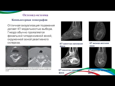 Остеоид-остеома Компьютерная томография Отличная визуализация поражения делает КТ модальностью выбора. Гнездо обычно
