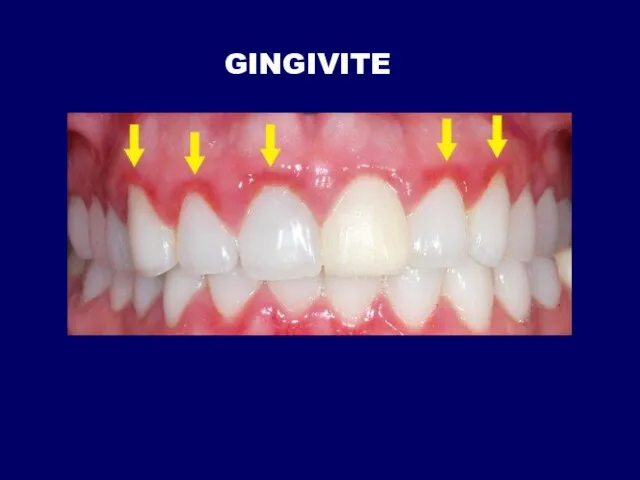 GINGIVITE